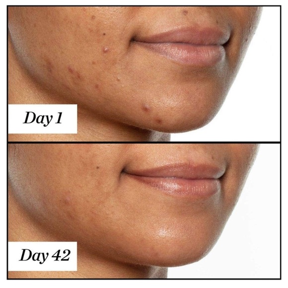 Sunday Riley U.F.O. Ultra-Clarifying Salicylic Acid Acne Treatment Face Oil - Picture 3 of 4